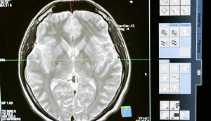 meningite - pexels- corrierecomo